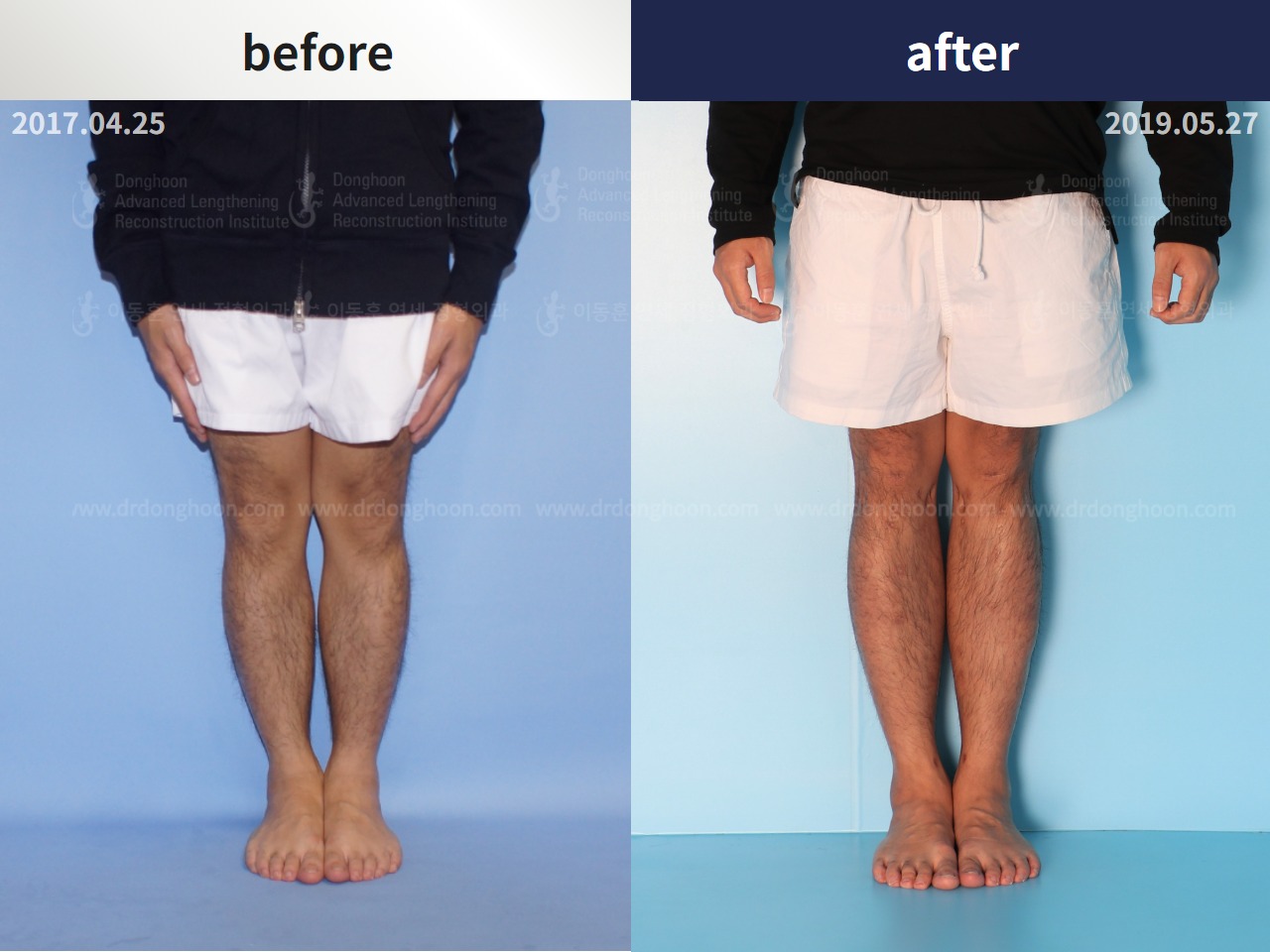 Before and after congenital condition, case 4300006, image 1, Dr. Donghoon institute (DALRI)