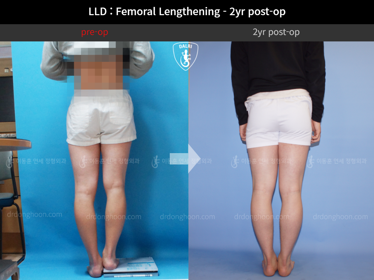 Before and after adult lld, case 4320322, image 2, Dr. Donghoon institute (DALRI)