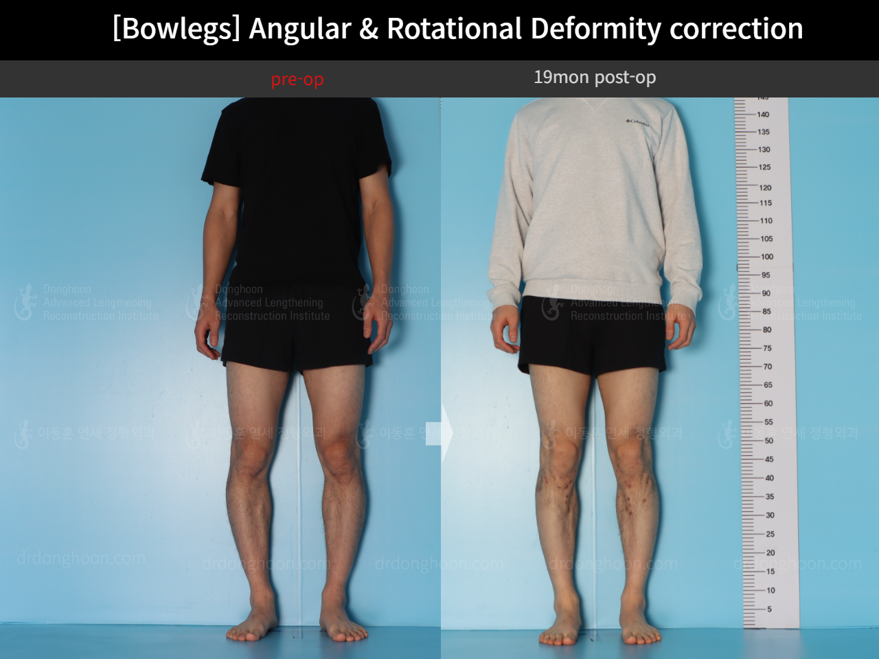 Before and after adult bowlegs, case 18306379, image 4, Dr. Donghoon institute (DALRI)
