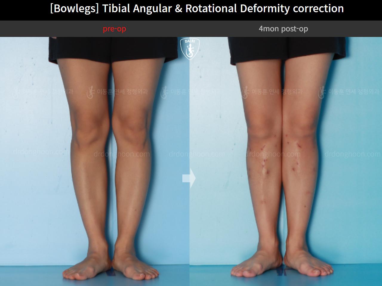 Before and after adult bowlegs, case 16530390, image 8, Dr. Donghoon institute (DALRI)