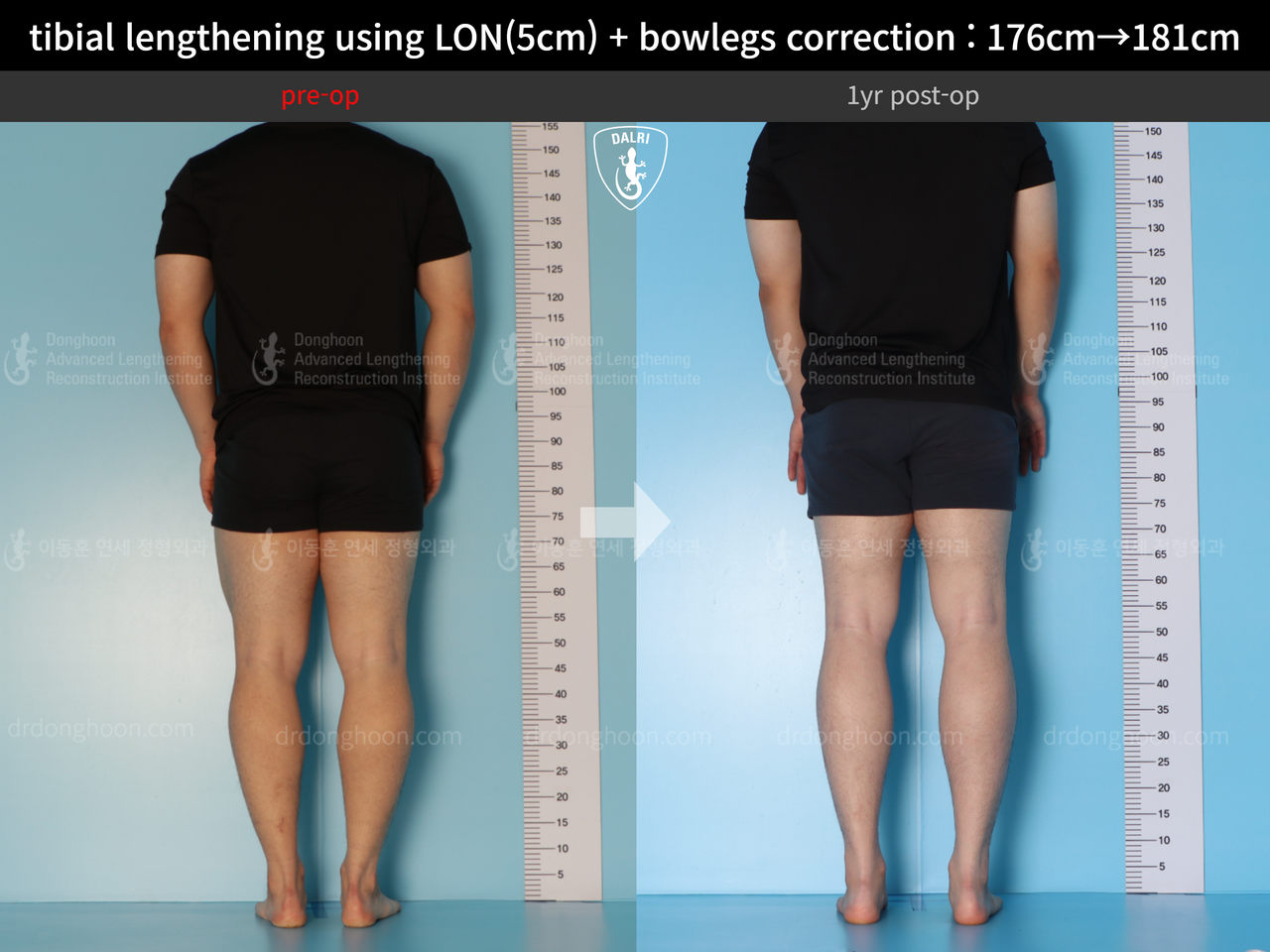 Before and after cll + deformity correction, case 13410849, image 4, Dr. Donghoon institute (DALRI)