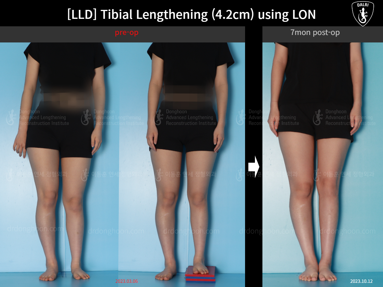 Before and after adult lld, case 16933852, image 1, Dr. Donghoon institute (DALRI)