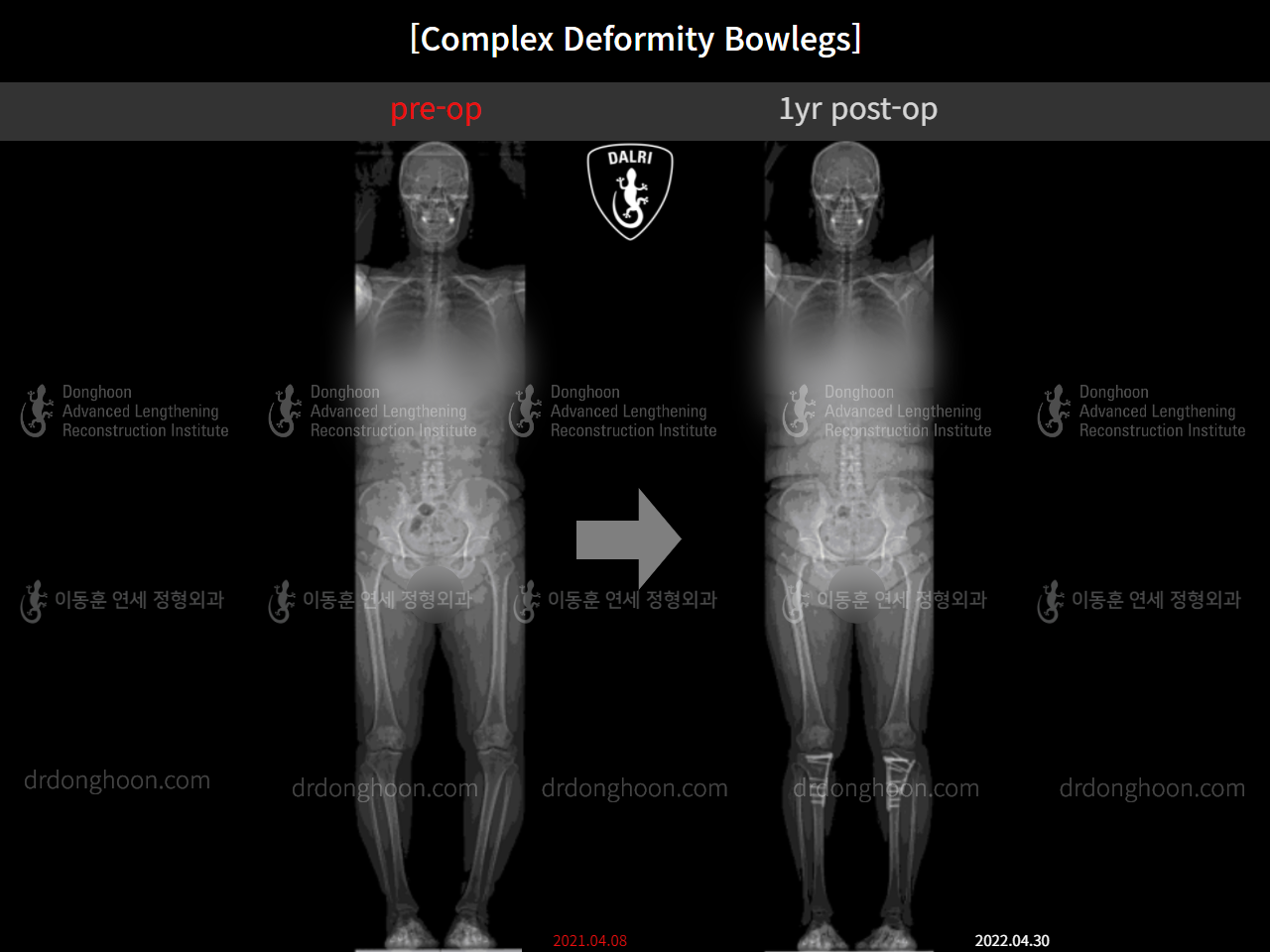 Before and after complex deformity, case 11339608, image 7, Dr. Donghoon institute (DALRI)