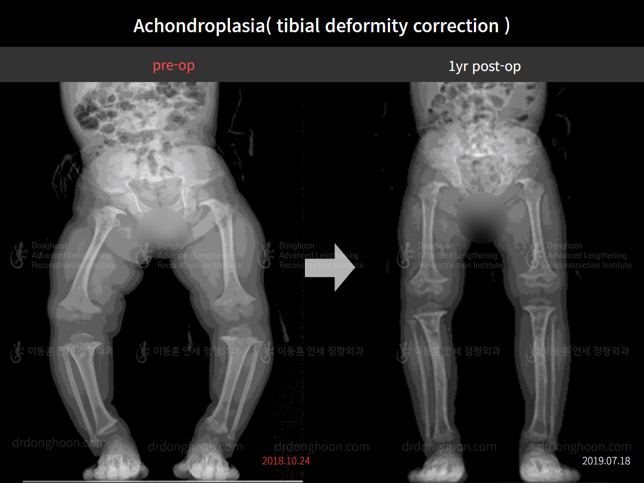 Before and after paediatric congenital condition, case 4304782, image 3, Dr. Donghoon institute (DALRI)