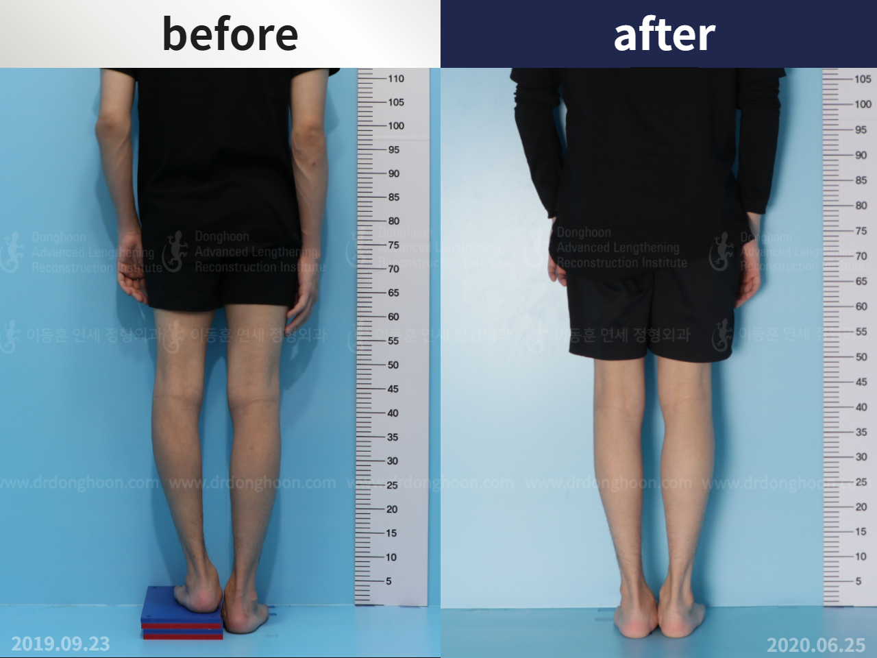 Before and after paediatric & adolescent lld, case 4684461, image 3, Dr. Donghoon institute (DALRI)