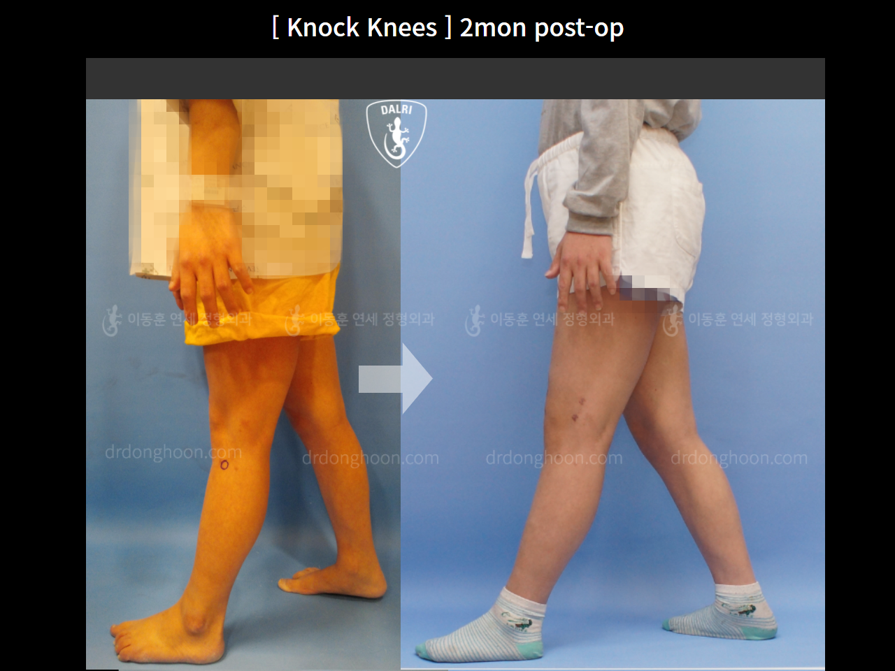 Before and after adult knock knees, case 4640593, image 4, Dr. Donghoon institute (DALRI)