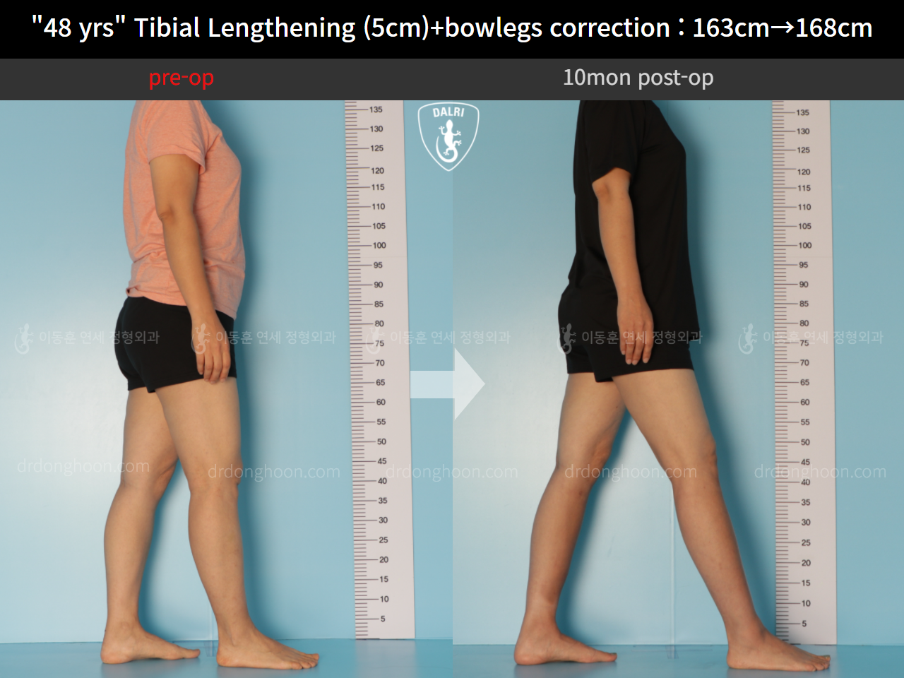 Before and after cll precice, case 10474341, image 3, Dr. Donghoon institute (DALRI)