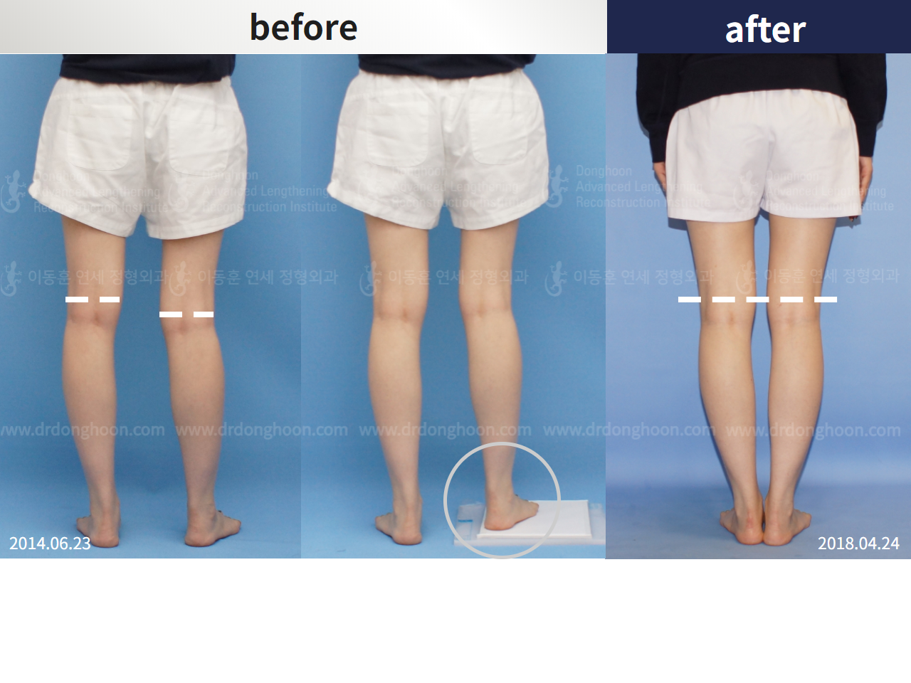 Before and after adult lld, case 4472980, image 3, Dr. Donghoon institute (DALRI)