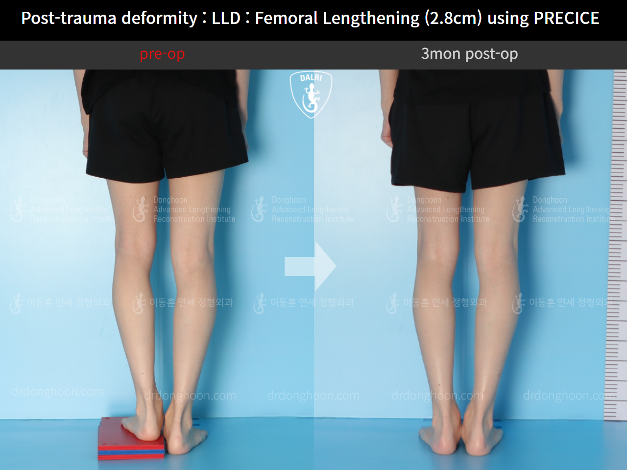 Before and after post-trauma deformity, case 10452246, image 4, Dr. Donghoon institute (DALRI)