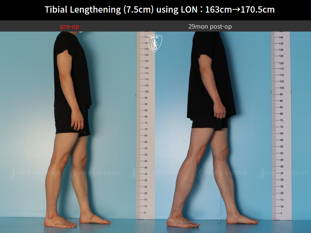 Before and after cll lon, case 127341676, image 4, Dr. Donghoon institute (DALRI)