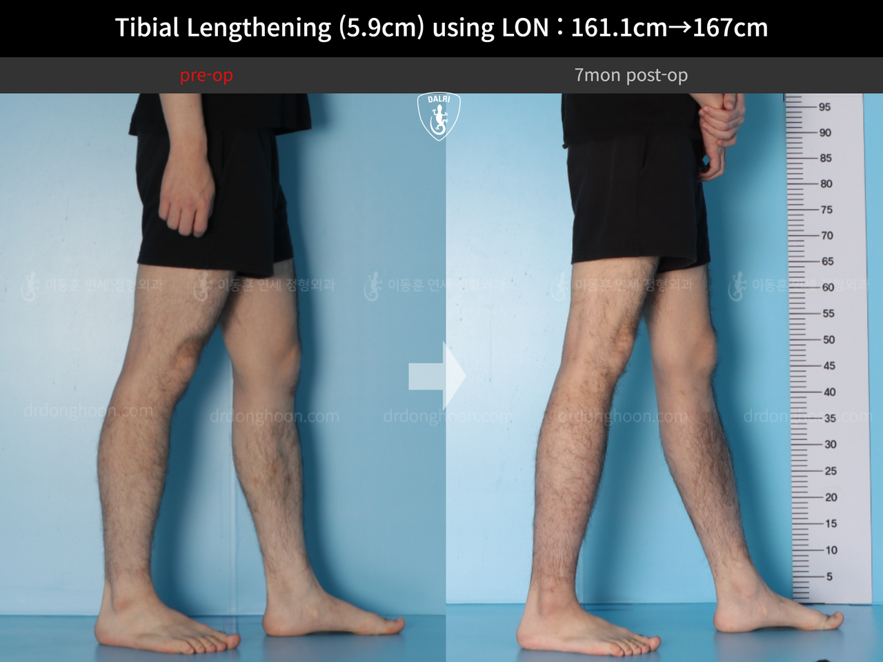Before and after cll lon, case 14064750, image 8, Dr. Donghoon institute (DALRI)