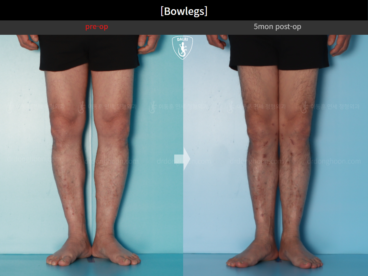 Before and after adult bowlegs, case 24988060, image 7, Dr. Donghoon institute (DALRI)