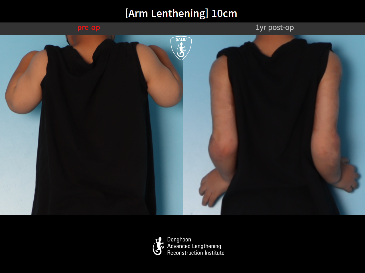 Before and after arm lengthening, case 31284248, image 3, Dr. Donghoon institute (DALRI)