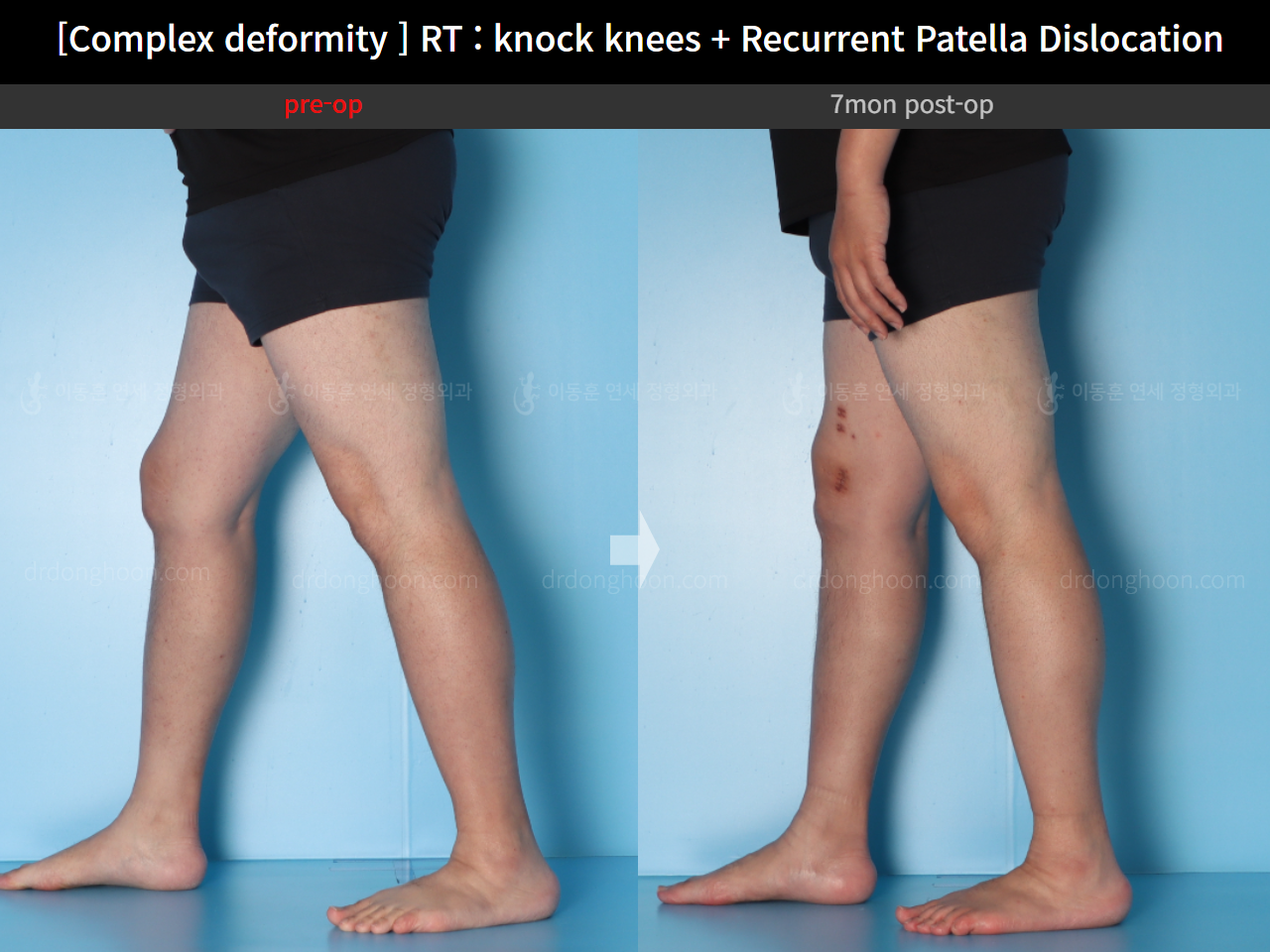 Before and after recurrent patella dislocation, case 16147031, image 9, Dr. Donghoon institute (DALRI)