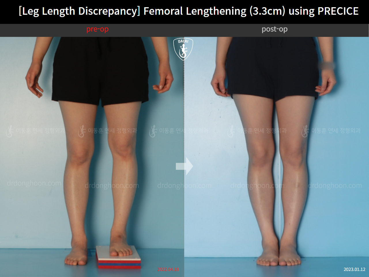 Before and after adult lld, case 22355841, image 5, Dr. Donghoon institute (DALRI)