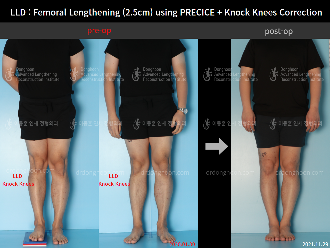 Before and after adult lld, case 9016415, image 1, Dr. Donghoon institute (DALRI)