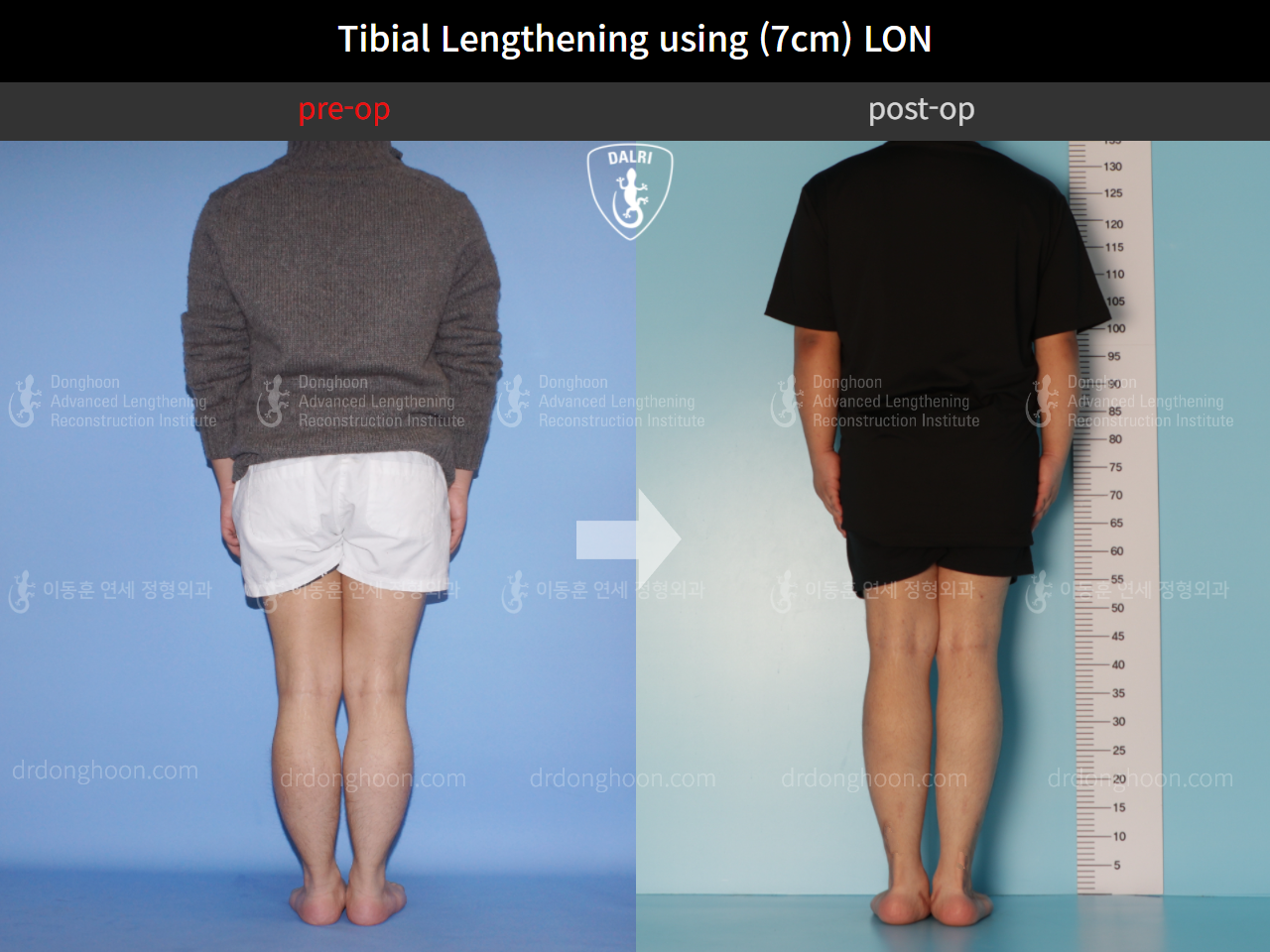 Before and after cll lon, case 10452499, image 2, Dr. Donghoon institute (DALRI)