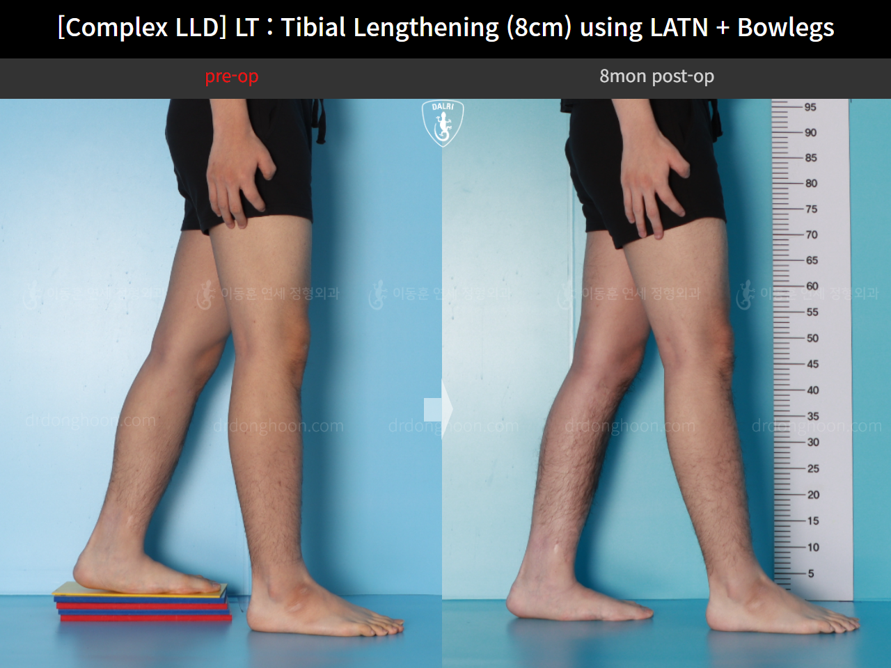 Before and after complex deformity, case 16724288, image 7, Dr. Donghoon institute (DALRI)