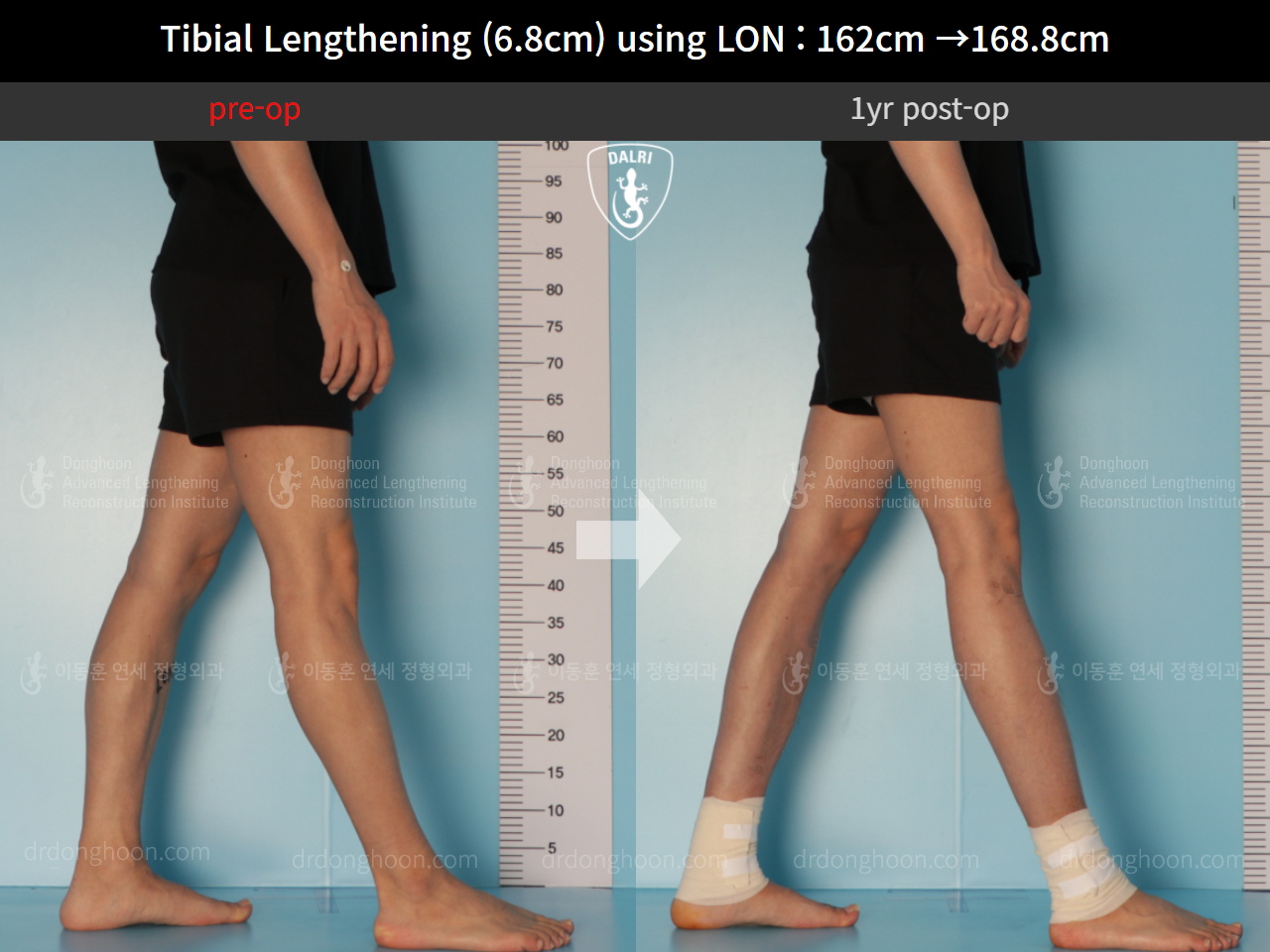 Before and after cll lon, case 10294551, image 7, Dr. Donghoon institute (DALRI)