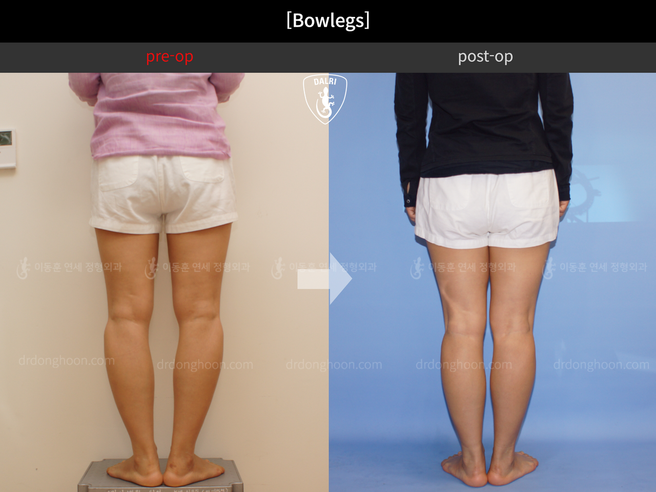 Before and after adult bowlegs, case 4311016, image 4, Dr. Donghoon institute (DALRI)