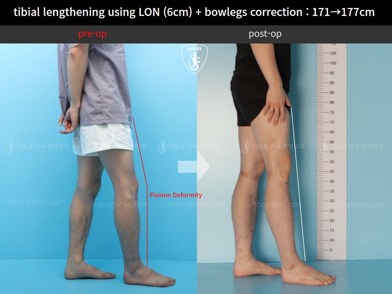 Before and after cll + deformity correction, case 11798378, image 4, Dr. Donghoon institute (DALRI)