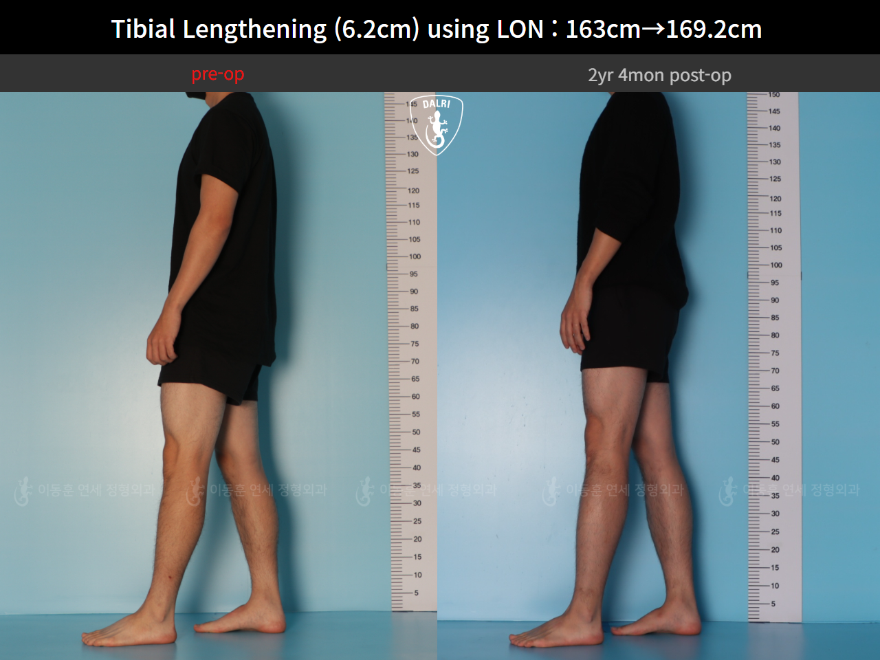 Before and after cll lon, case 128449546, image 3, Dr. Donghoon institute (DALRI)