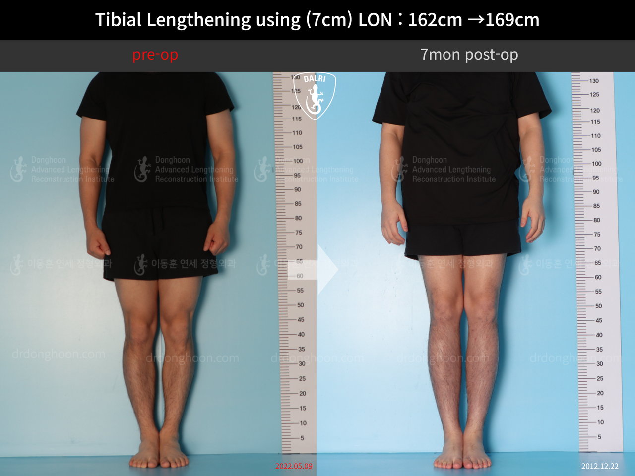 Tibial Lengthening Using (7cm) LON : 162cm →169cm : 7mon Post-op ...