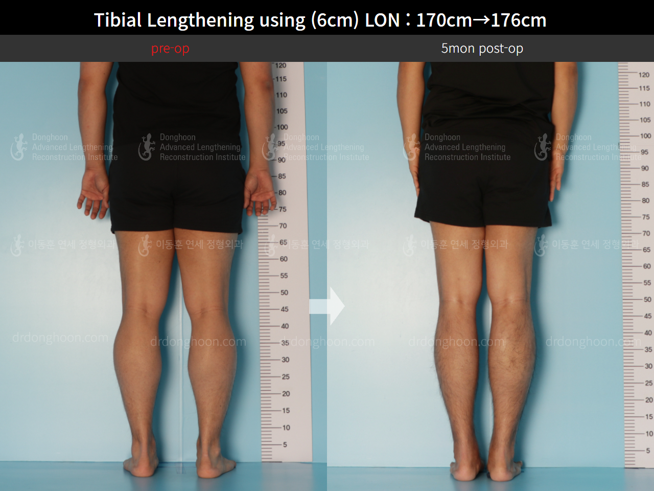 Before and after cll lon, case 8672248, image 6, Dr. Donghoon institute (DALRI)