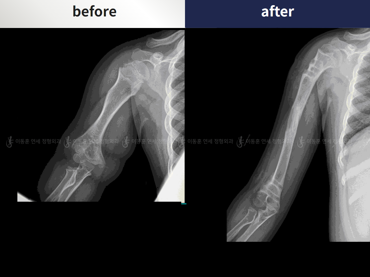 Before and after arm lengthening, case 4249492, image 3, Dr. Donghoon institute (DALRI)
