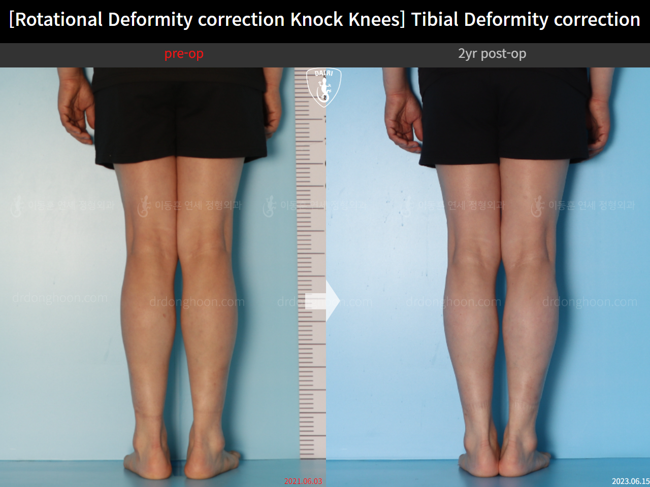 Before and after adult knock knees, case 15524370, image 7, Dr. Donghoon institute (DALRI)