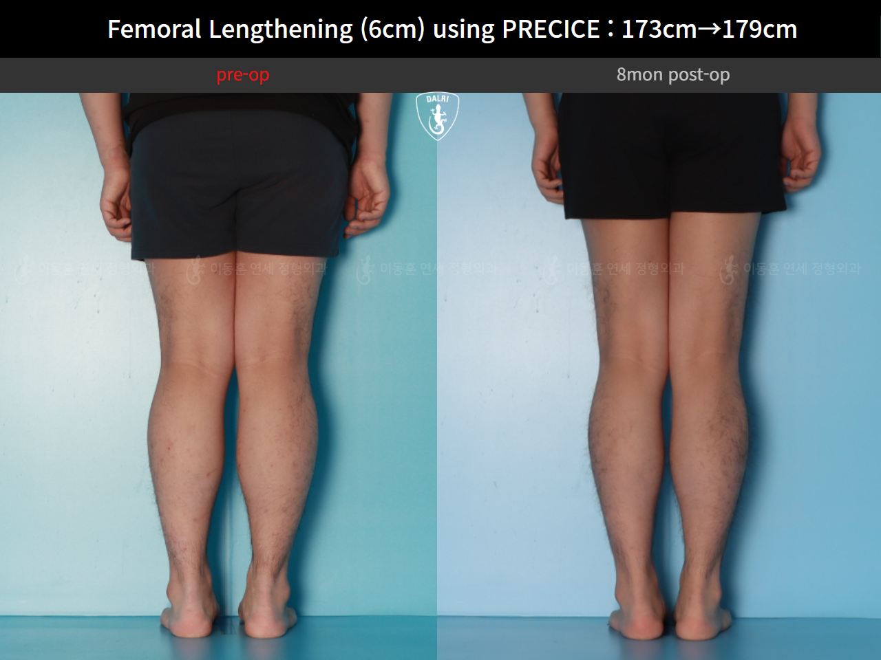 Before and after cll precice, case 89066969, image 8, Dr. Donghoon institute (DALRI)