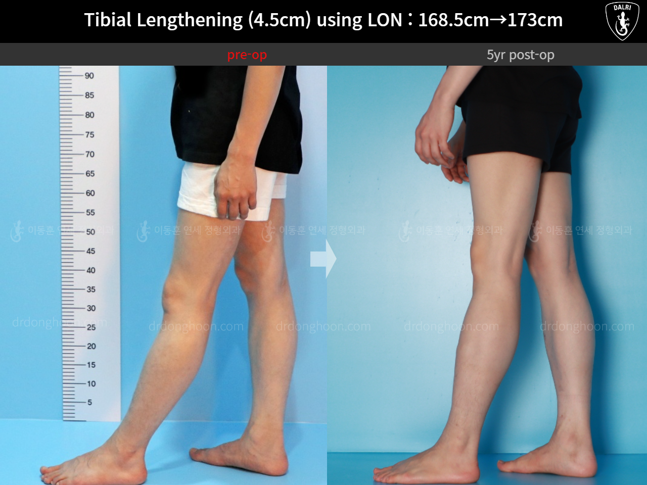 Before and after cll lon, case 16140967, image 10, Dr. Donghoon institute (DALRI)