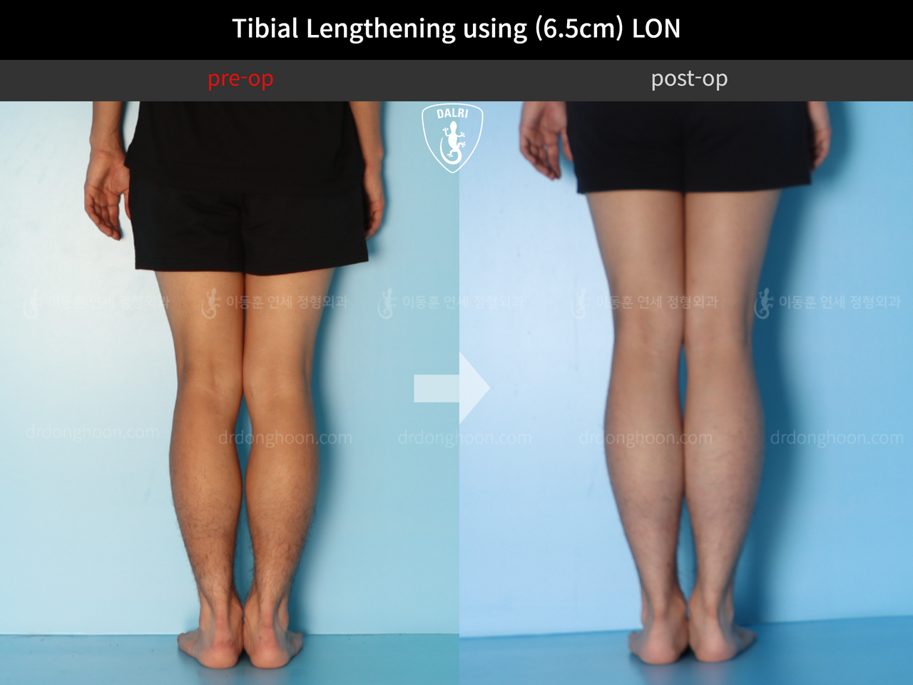 Before and after cll lon, case 12242145, image 5, Dr. Donghoon institute (DALRI)