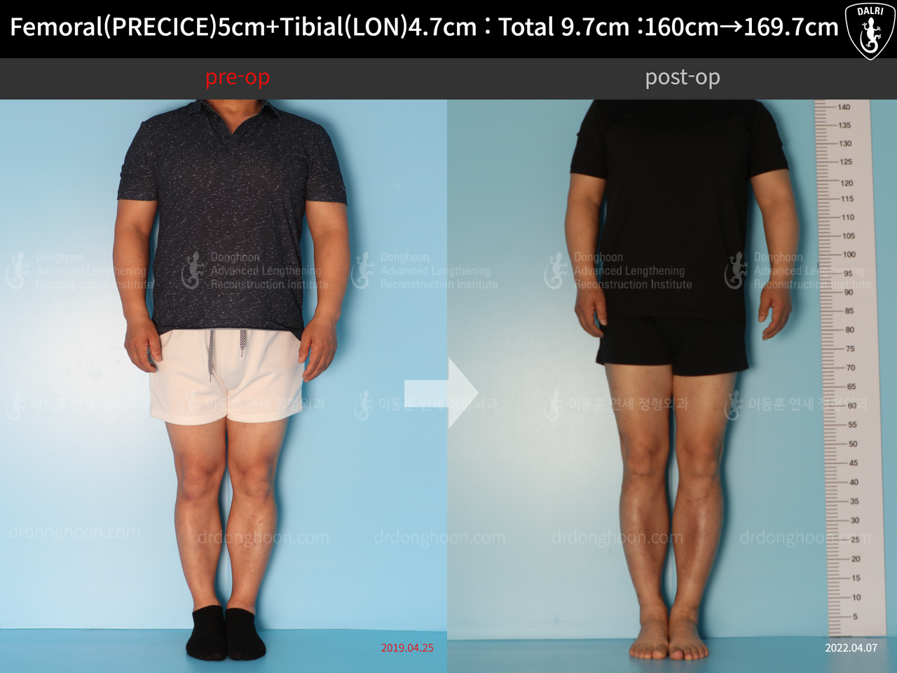 Before and after cll precice, case 7755066, image 3, Dr. Donghoon institute (DALRI)