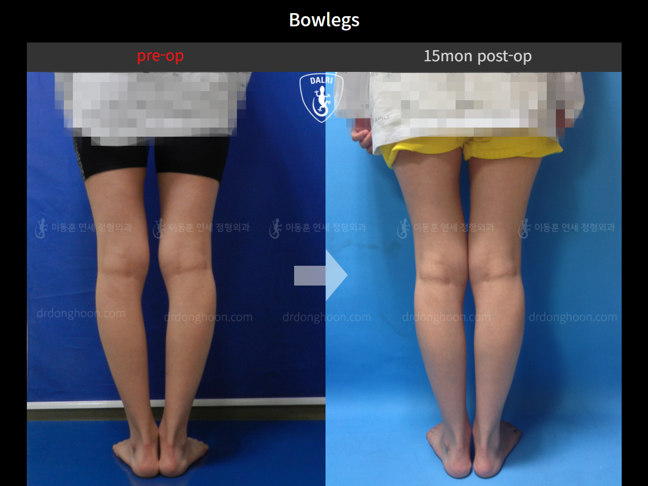 Before and after adult bowlegs, case 4310970, image 6, Dr. Donghoon institute (DALRI)