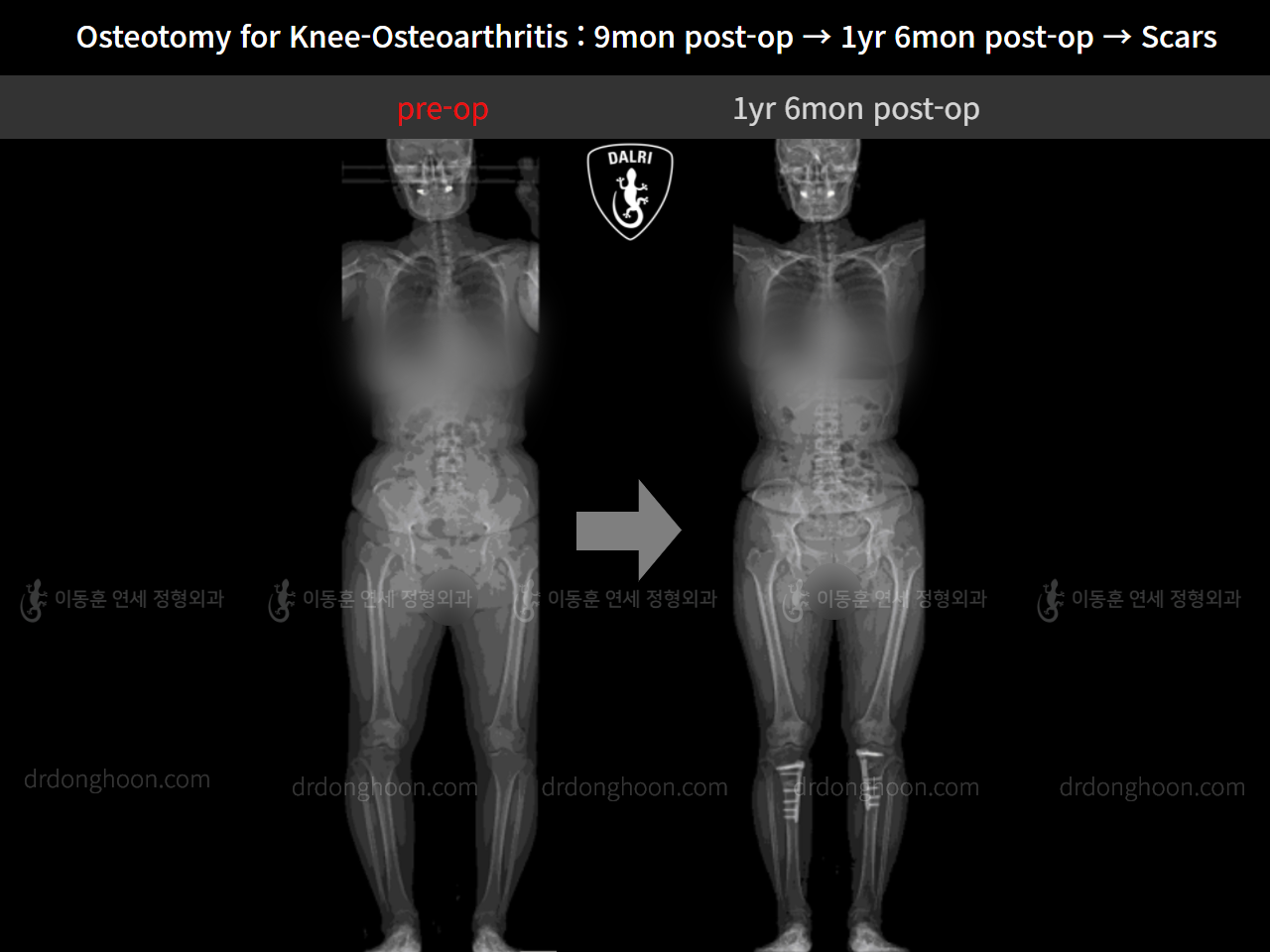 Before and after osteotomy for knee osteoarthritis, case 11203744, image 8, Dr. Donghoon institute (DALRI)