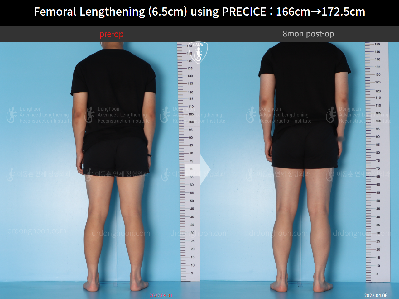 Before and after cll precice, case 14706614, image 4, Dr. Donghoon institute (DALRI)