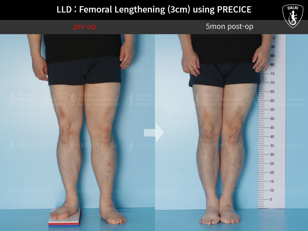 Before and after adult lld, case 5346187, image 5, Dr. Donghoon institute (DALRI)