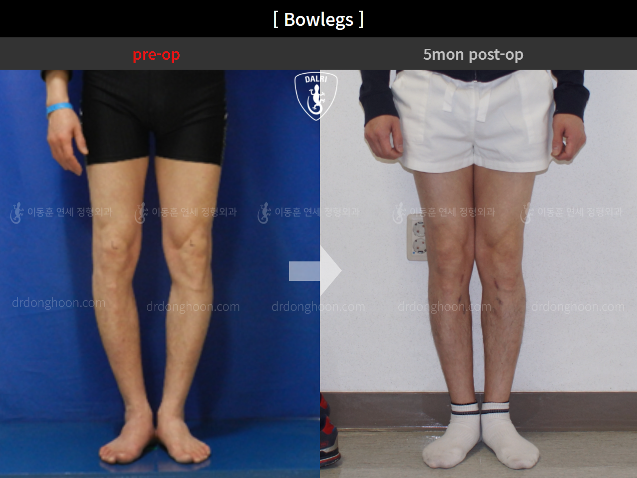 Before and after adult bowlegs, case 4586208, image 4, Dr. Donghoon institute (DALRI)