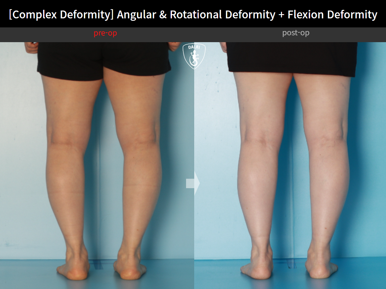 Before and after adult bowlegs, case 16781344, image 10, Dr. Donghoon institute (DALRI)