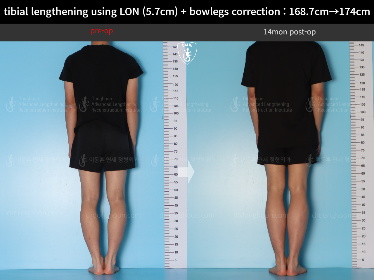 Before and after cll + deformity correction, case 18160780, image 2, Dr. Donghoon institute (DALRI)