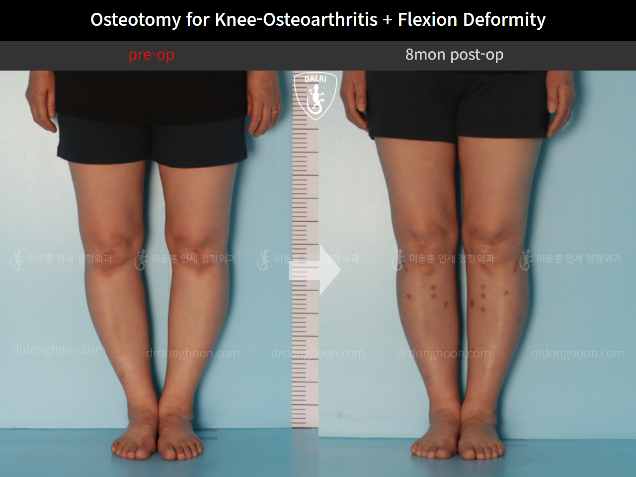 Before and after osteotomy for knee osteoarthritis, case 10663581, image 5, Dr. Donghoon institute (DALRI)