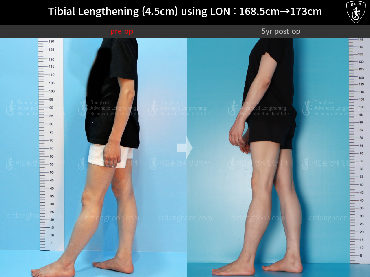 Before and after cll lon, case 16140967, image 6, Dr. Donghoon institute (DALRI)