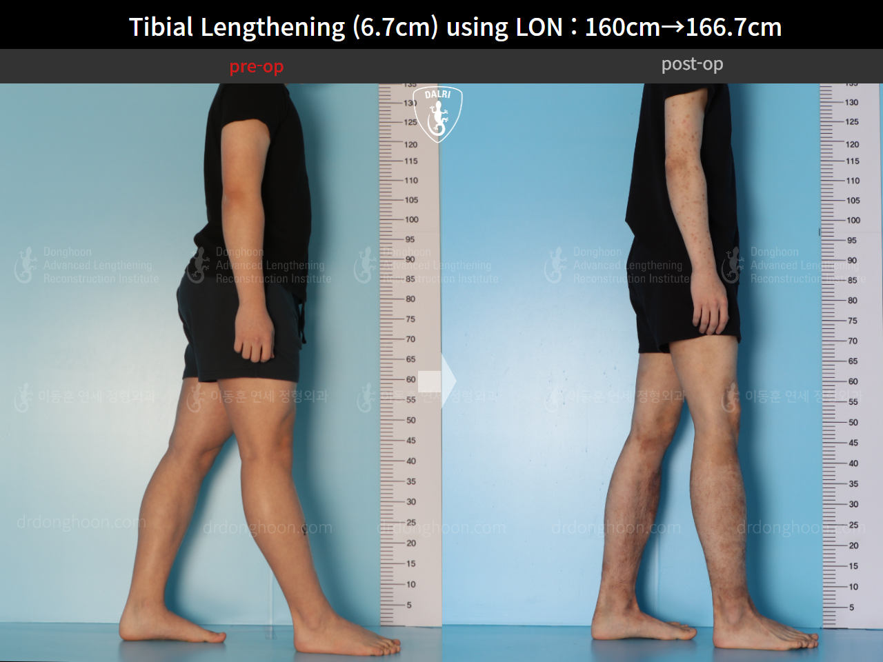 Before and after cll lon, case 15544530, image 4, Dr. Donghoon institute (DALRI)