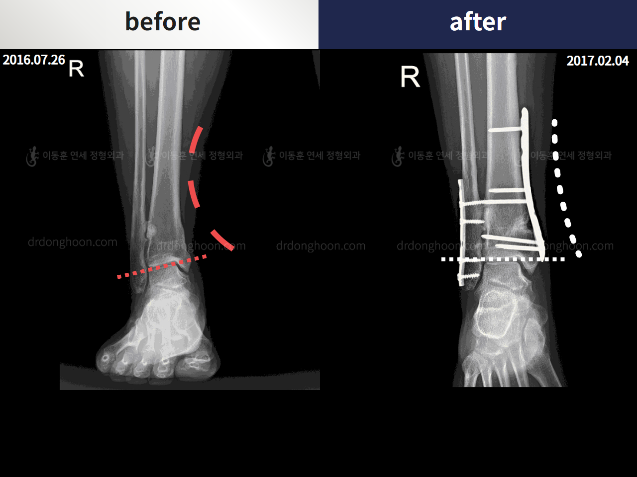 Before and after foot & ankle deformity, case 4247987, image 4, Dr. Donghoon institute (DALRI)