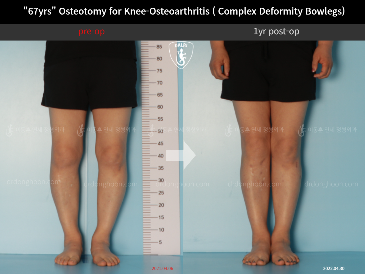 Before and after adult bowlegs, case 11339434, image 5, Dr. Donghoon institute (DALRI)