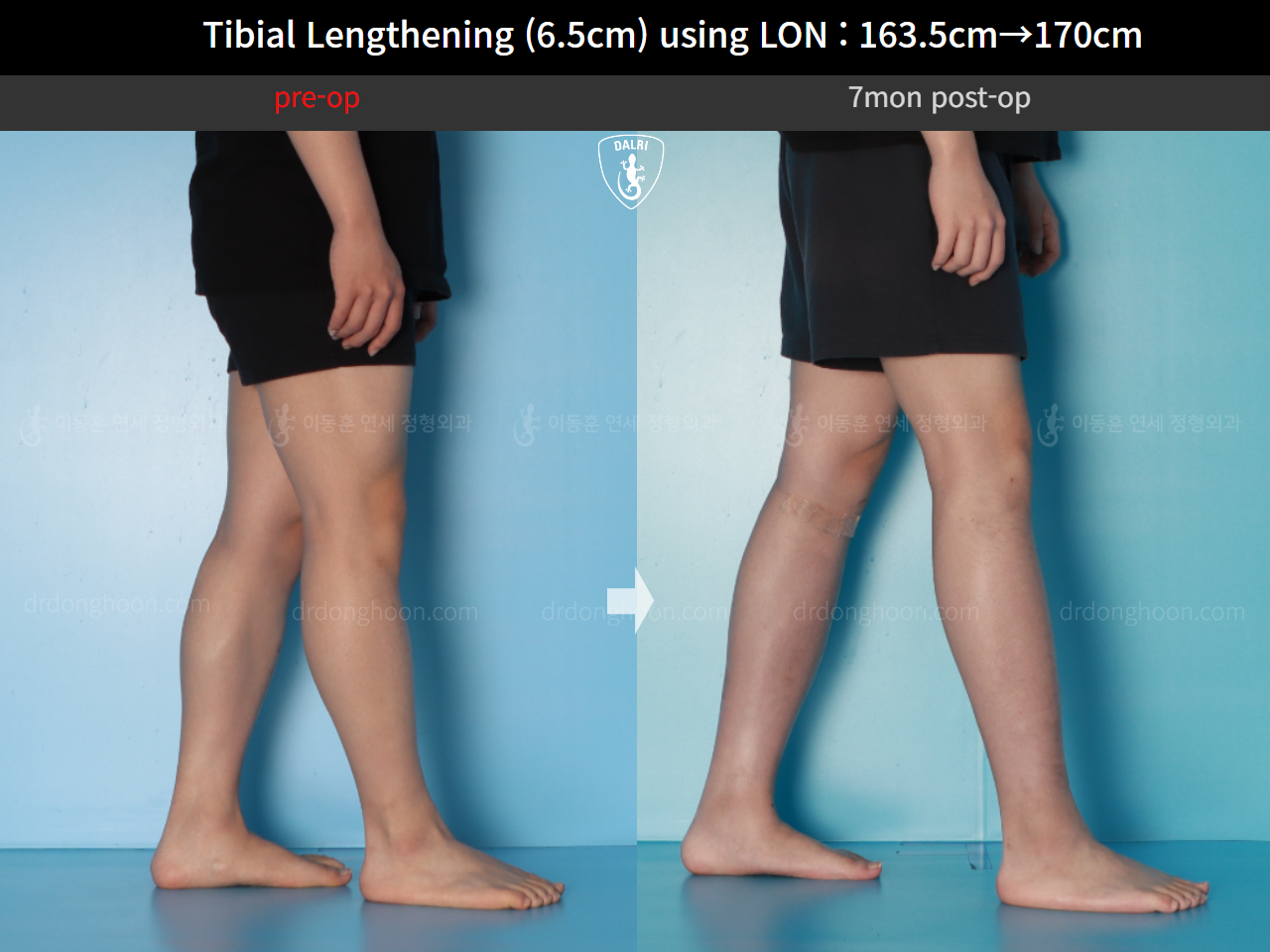 Before and after cll lon, case 17199046, image 8, Dr. Donghoon institute (DALRI)