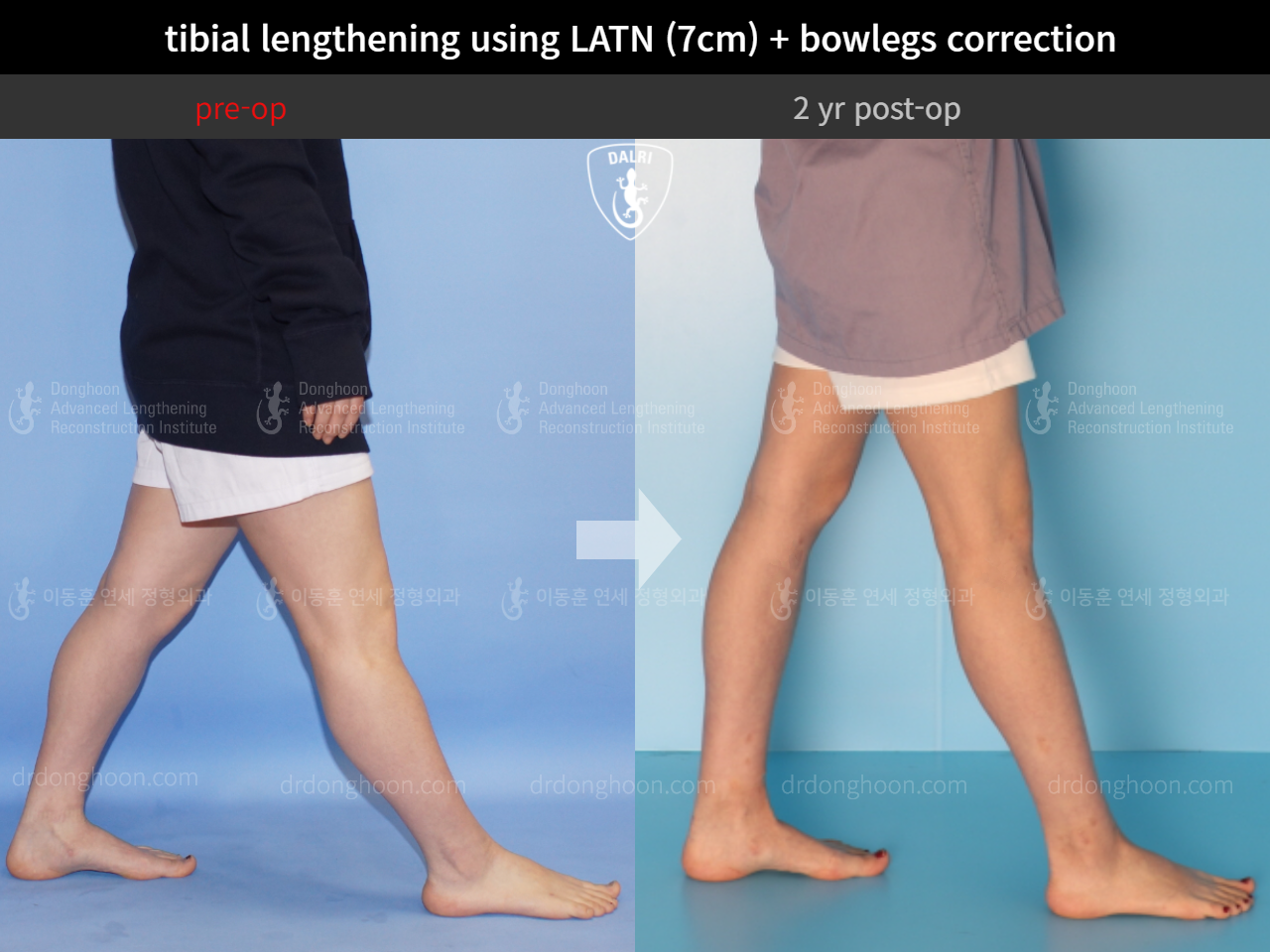 Before and after cll + deformity correction, case 9278561, image 8, Dr. Donghoon institute (DALRI)