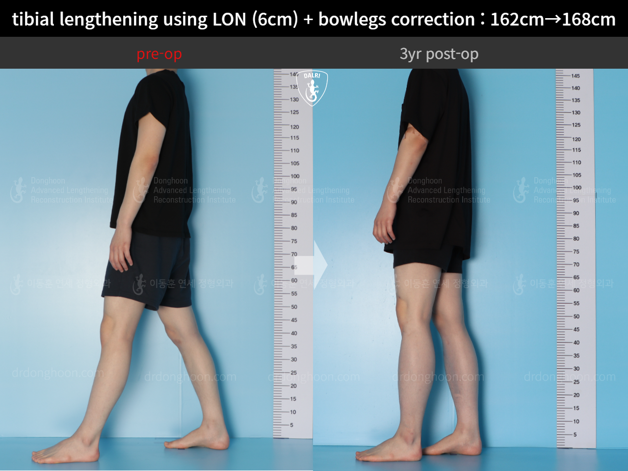 Before and after cll + deformity correction, case 14731799, image 3, Dr. Donghoon institute (DALRI)