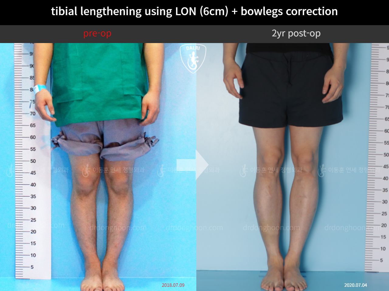 Before and after cll + deformity correction, case 4323141, image 5, Dr. Donghoon institute (DALRI)